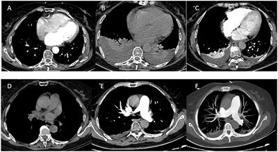 Massive pleural effusion following high-power and short-duration radiofrequency ablation for treatment of atrial fibrillation: A case report and review of the literature